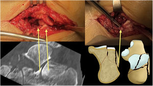 Abordaje del seno del tarso y visualización de la faceta posterior y pared lateral de la fractura.