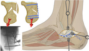 Osteosíntesis con placa de fractura de calcáneo a través de un abordaje del seno del tarso modificado.
