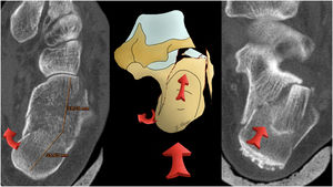 Patoanatomía de la fractura: desplazamiento de la tuberosidad posterior en varo y proximal.