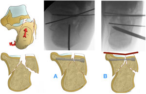 La tuberosidad posterior no reducida impide la correcta reducción de los fragmentos articulares.