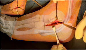 Abordaje del seno del tarso en una fractura de calcáneo.