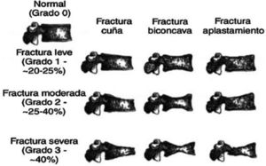 Clasificación de las fracturas vertebrales osteoporóticas de Genant5.