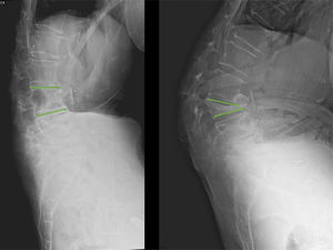 Se muestra el caso de una paciente con una fractura vertebral por insuficiencia, manejada ortopédicamente. Nótese la progresión de la cifosis y el consecuente disbalance sagital.