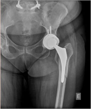 Anteroposterior radiographic view of a periprosthetic Vancouver B2 type fracture.