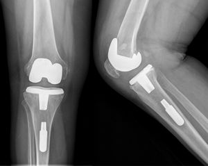 AP and lateral radiographs showing a unconnected tibial stem in a NMC protheses implanted in a 63-year-old woman because of a 15° valgus deformity of the right knee.