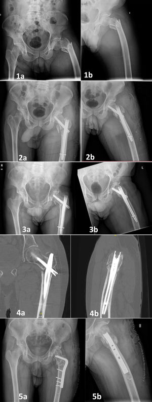 Male, 65-year old, 31.A3.3 fracture. Smoker (10cigarettes/day). Ex-alcoholic. Ex-drug user. No allergies. HIV infection, pancreas insufficiency, hepatic cirrhosis. Prior surgery for clavicle fracture. He developed an atrophic non-union, which required an desrotatory osteotomy. This patient is currently under follow-up. 1a: Anteroposterior X-ray at Emergency Department. 1b: Axial X-ray at Emergency Department. 2a: Anteroposterior X-ray first day after surgery. 2b: Axial X-ray first day after surgery. 3a: Anteroposterior X-ray at one year follow-up. Varization and non-union can be observed. 3b: Axial X-ray at one year follow-up. Varization and non-union can be observed. 4a: Coronal image of CT-scan at one year follow-up, showing no signs of union. 4b: Sagital image of CT-scan at one year follow-up, showing no signs of union. 5a: Anteroposterior X-ray first day after reintervention. 5b: Axial X-ray first day after reintervention.