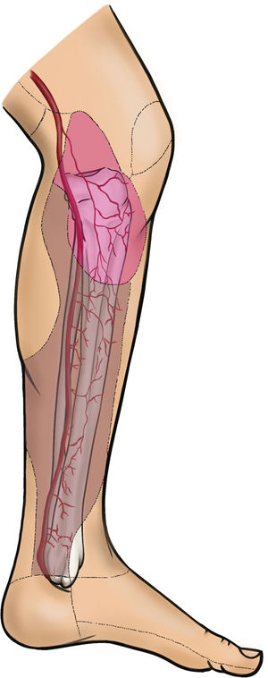 Irrigación del colgajo de lengüeta medial.