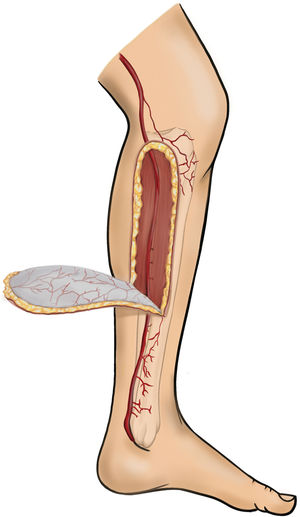 Colgajo de lengüeta medial para defectos del tercio proximal y medial de la tibia.