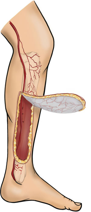 Colgajo de lengüeta medial para defectos del tercio distal de la tibia.