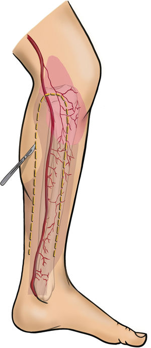 Marcación de incisiones (anterior y posterior) del colgajo de lengüeta medial.