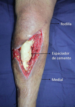 Paciente masculino de 40 años con defecto de cobertura en tercio medial y proximal de la pierna, GIIIB abierto con defecto óseo crítico.