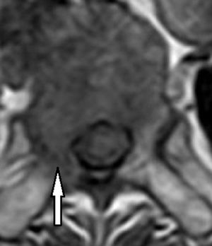 Imagen axial de RM potenciada en T1. Asimetría de hipointensidad de señal con afectación de pedículo derecho (flecha) por metástasis.