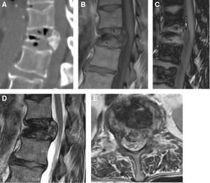 A. Imagen sagital de TC de fractura compresión en T12. Obsérvese el gas en la columna anterior, así como el gas intradiscal. B. Imagen sagital de RM potenciada en T1 en fase. Nótese el área hipointensa en columna anterior que corresponde al gas intraóseo observado en TC. C. Imagen sagital de RM potenciada en T1 en fuera de fase. La médula ósea normal pierde intensidad de señal (se hace hipointensa), salvo el hueso infiltrado con médula ósea patológica (flecha) en columna media. D. Imagen sagital de RM potenciada en T2. Permite distinguir la invasión del conducto espinal con mejor precisión que las imágenes en T1. E. Imagen axial de RM potenciada en T2. Nótese la protrusión convexa del fragmento óseo en conducto espinal.