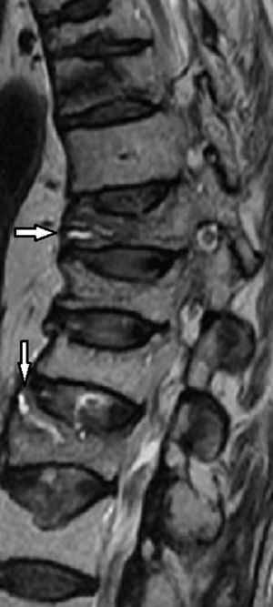 Imagen sagital de RM potenciada en T2. Nótese el signo de fluido como hiperintenso en T2, asociado a fracturas agudas en T2 (flechas). Así mismo otras fracturas osteoporóticas crónicas, entre las dos flechas y craneal a la flecha horizontal.