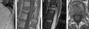 A. Mujer de 52 años con antecedentes de carcinoma de mama HER2+++ sin tratamiento actual, que acude por dolor en hipocondrio derecho. Radiografía lateral donde se observa fractura grado 1 en T12. B. Imagen sagital de RM potenciada en T1 donde se aprecia la hipointensidad en banda de la mitad superior vertebral debida al edema intraóseo. C. Imagen sagital de RM potenciada en T2 con saturación grasa donde se aprecia la retropulsión convexa de la columna media en conducto espinal (flecha), además del edema intraóseo. D. Imagen axial de RM potenciada en T1. Nótese simetría en la intensidad de señal de los pedículos vertebrales.