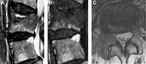 A. Imagen sagital de RM potenciada en T2. Se observa fractura de L2 con signo de fluido con hiperintensidad de señal en el platillo superior, pero lesión hipointensa subyacente. B. Imagen sagital de RM potenciada en T1. Se observa la hipointensidad de señal horizontal en el platillo superior, confundida con la lesión hipointensa subyacente. C. Imagen axial de RM potenciada en T1. Se aprecia la hipointensidad de señal con destrucción de pedículo derecho por metástasis.