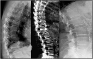 Imagen de Rx convencional con fractura vertebral osteoporótica con acuñamiento del cuerpo vertebral. Fractura vertebral severa de T12. Imagen de columna tóraco-lumbar (centro) y radiografías de columna torácica (izquierda) y columna lumbar (derecha) de la misma paciente.