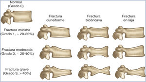 Categorización de las fracturas vertebrales de acuerdo a la clasificación de Genant et al.17.