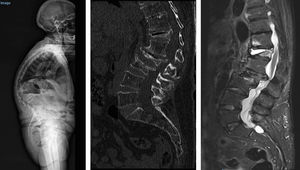 TeleRx, TC y RM de columna de una mujer de 82 años con fracturas vertebrales osteoporóticas múltiples en charnela dorsolumbar L3, L2 con invasión del canal y D12 (enfermedad de Kümmell) con severa deformidad.