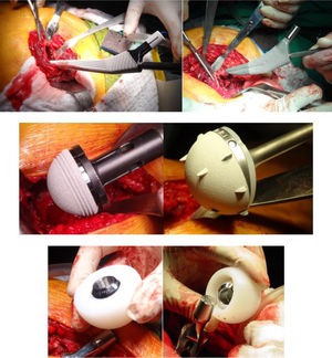Trans-surgical images of total hip arthroplasty with DM system.
