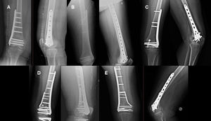 Clinical cases treated with plates: compression plate (A), bridge plating (B), bridge plating combined with compression screw for Hoffa's fracture (C), and double anti-slip plate systems (D and E).