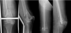 Clinical case: supracondylar femoral fracture type A (AO/OTA) treated by retrograde intramedullary nailing.