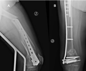 Examples of material failures: peri-implant fracture (A). Failure of locking plate screws (B).