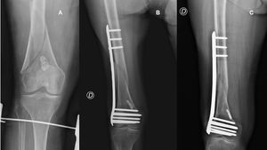 Case of delayed union. Image of initial fracture (A), early postoperative (B) and at 6 months follow-up (C).