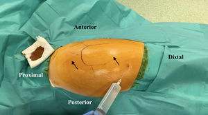 Instilación preoperatoria de anestésico local y vasoconstrictor con aguja espinal en una cadera izquierda. Las flechas indican la posición de los portales endoscópicos.