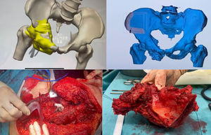 Planificación y diseño de las guías 3D. A) Modelo tridimensional de la pelvis y el tumor con la guía impresa en 3D resaltada en amarillo. B) Visualización de la guía 3D acoplada a la pelvis en un modelo tridimensional. C) Imagen intraoperatoria mostrando la colocación de la guía 3D en el paciente. D) La pieza resecada, incluyendo el tumor, se muestra para verificación postoperatoria.