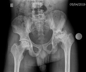 Radiografía anteroposterior de pelvis con marcador metálico esférico de 26mm para la calibración y la planificación digital.