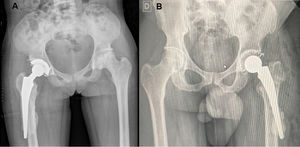 A) Paciente mujer de 26 años afecta de anemia drepanocítica e intervenida de artroplastia total de cadera derecha híbrida mediante abordaje lateral. B) Paciente varón de 43 años de edad intervenido de artroplastia total de cadera izquierda cementada mediante abordaje anterior directo, debido a un fracaso de osteosíntesis de fractura de cuello femoral. En ambas imágenes se aprecia la perforación del canal con salida de cemento y un segmento del vástago fuera del canal endomedular.