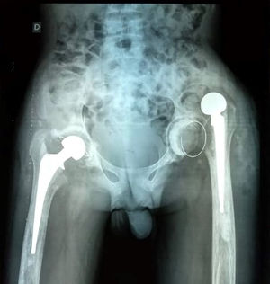 Paciente varón de 24 años de edad afecto de anemia drepanocítica, e intervenido de artroplastia total de cadera bilateral mediante abordaje anterior directo. Se aprecia movilización del componente acetabular de la cadera izquierda y luxación de la artroplastia.