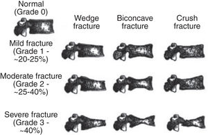 The Genant classification of osteoporotic fractures.5