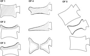 Classification of osteoporotic fractures proposed by the DGOU.28