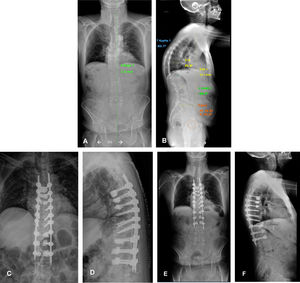 Male, 71 years old, who suffered a fall from standing height in January 2023. Since then, he has presented with dorsolumbar pain. Images A and B show a teleradiograph showing the significant sagittal imbalance caused by multiple vertebral fractures, resulting in hyperkyphosis. Images C and D show the first postoperative X-ray. Long posterior instrumentation was performed, with minimally invasive techniques and cement augmentation of the most cranial and caudal screws. Images E and F show the first postoperative teleradiograph, at one month, where the restoration of sagittal balance is evident.