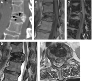 (A) Sagittal CT image of compression fracture at T12. Note the gas in the anterior spine, and also the intradiscal gas. (B) Sagittal in-phase T1-weighted MR image. Note the hypointense area in the anterior spine that corresponds to the intraosseous gas observed on CT. (C) Sagittal out-of-phase T1-weighted MR image. The normal bone marrow loses signal intensity (becomes hypointense), except for the bone infiltrated with pathological bone marrow (arrow) in the medial spine. (D) Sagittal T2-weighted MR image. We may distinguish invasion of the spinal canal with better precision than T1 images. (E) Axial T2-weighted MR image. Note the convex protrusion of the bone fragment into the spinal canal.