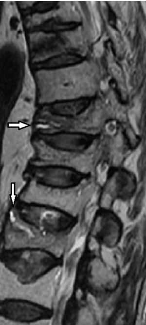 Sagittal T2-weighted MR image. Note the fluid sign as hyperintense on T2, associated with acute fractures on T2 (arrows). Also other chronic osteoporotic fractures, between the two arrows and cranial to the horizontal arrow.