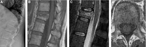 (A) 52-Year-old woman with a history of HER2+++ breast carcinoma without current treatment, presenting with pain in the right upper quadrant. Lateral X-ray showing grade 1 fracture at T12. (B) Sagittal T1-weighted MR image showing band-like hypointensity of the upper vertebral half due to intraosseous oedema. (C) Sagittal T2-weighted MR image with fat saturation showing convex retropulsion of the medial spine in the spinal canal (arrow), in addition to intraosseous oedema. (D) Axial T1-weighted MR image. Note symmetry in the signal intensity of the vertebral pedicles.