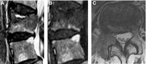 (A) Sagittal T2-weighted MR image. L2 fracture is observed with fluid sign with signal hyperintensity in the superior endplate, but underlying hypointense lesion. (B) Sagittal T1-weighted MR image. Horizontal signal hypointensity is observed in the superior endplate, confused with the underlying hypointense lesion. (C) Axial T1-weighted MR image. Signal hypointensity is seen with destruction of the right pedicle due to metastasis.