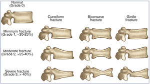 Classification of vertebral fractures according to Genant et al.17