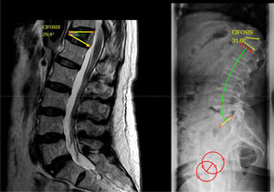 En el decúbito supino en la resonancia magnética se observa una cifosis de 29,4° que en la radiografía en bipedestación se mantiene en 31°. Por este motivo se considera una cifosis rígida.