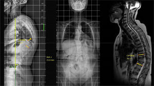 Caso con múltiples fracturas osteoporóticas que condicionan una cifosis global compensada y flexible con el decúbito.