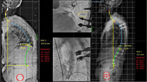 Ilustración de un caso con estadio 1ANC, en el que sin necesidad de realizar una osteotomía tricolumnar se observa una muy buena reducción intraoperatoria y se realiza una instrumentación larga percutánea T4-L2 y vertebroplastia de L3, L4 y L5 por presentar fracturas a dicho nivel.1 ANC: deformidad secundaria a fractura vertebral osteoporótica Angular, Flexible y No Compensada.