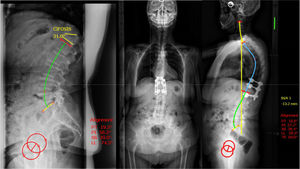 Ilustración de un caso con un estadio 1BC, en el que se observa que compensa con un mecanismo de hiperlordosis lumbar (nótese una lordosis lumbar de 74° para una incidencia pélvica de 54°). Se trató con una osteotomía de decancelación y una instrumentación corta y se observa en la radiografía de control del 5° año posoperatorio una normalización de la hiperlordosis lumbar.