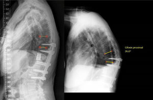 Complicación durante el seguimiento de una paciente con una artrodesis corta tras una cirugía de doble vía: síndrome de nivel adyacente proximal.