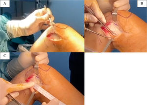 (A) 6cm distal femoral lateral approach is shown. (B) Subcutaneous dissection on iliotibial band. (C) Iliotibial band measured before cut, width of 15mm and a length of 20cm.