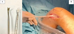 (A) Tenotome used for disection and final cut of the graft. (B) Iliotibial band graft cut leaving distal insertion in Gerdy