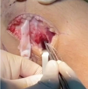 Dissection of posterolateral corner, and passing sutures behind condyle until being taken by the large curved dissector already inserted arthroscopically from anteromedial portal.