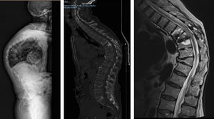 TeleRx, CT, and MRI of the spine of a 77-year-old male with multiple osteoporotic vertebral fractures in the dorsal spine D7, D8, and D11 causing severe angular kyphosis.